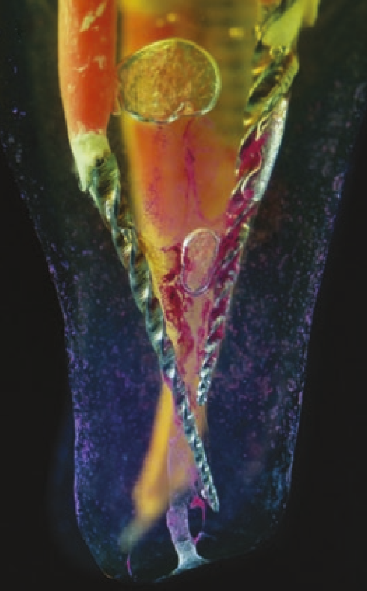 Cleared mesial root of a lower molar showing canal curvature and instrument position.