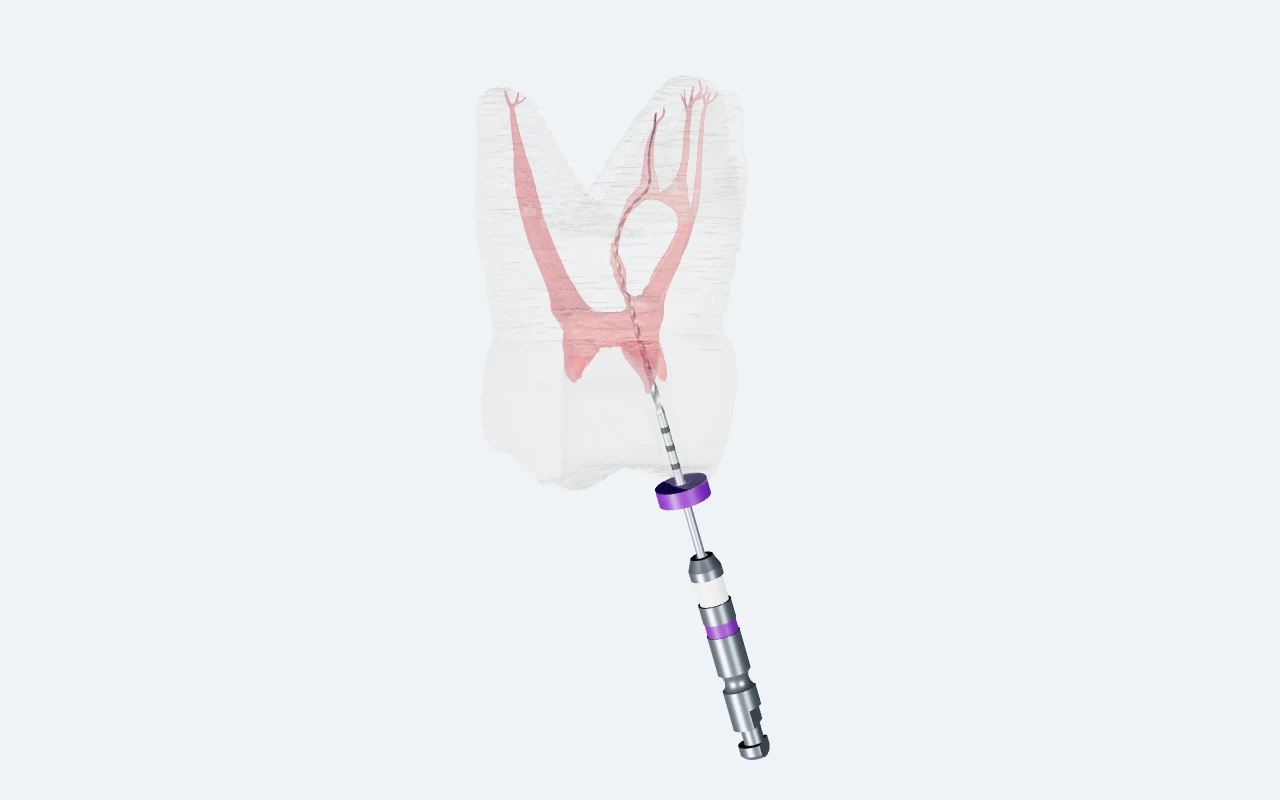 Upper first molar with translucent exterior, red canals and a MicroPath file following MB2; its handle is outside the crown.