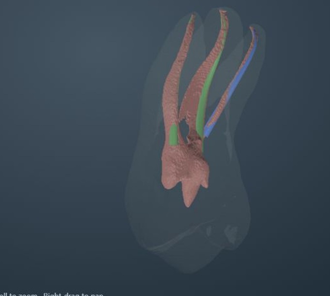 Complete molar ACTA 0003