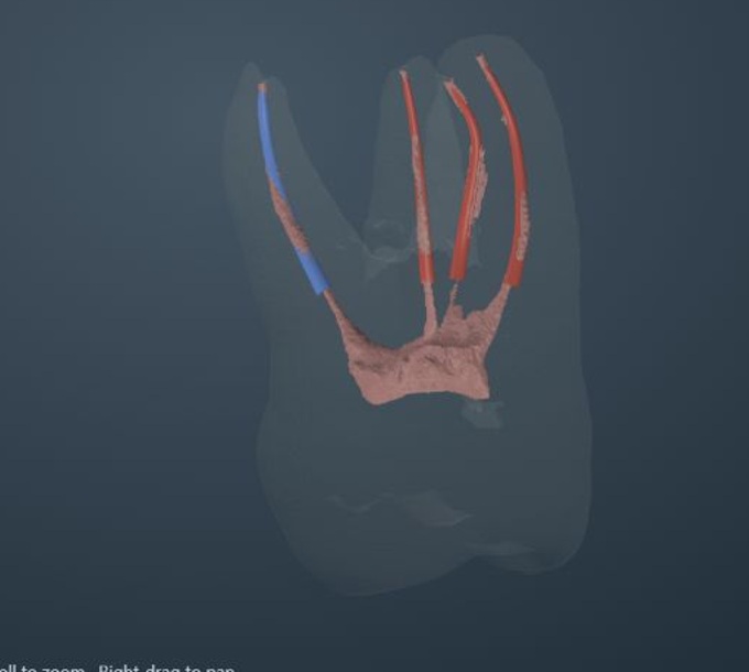 Complete molar ACTA 0093