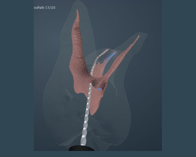 Complete molar ACTA 0113