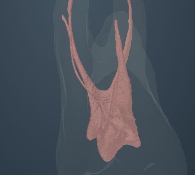 Complete molar ACTA 0115