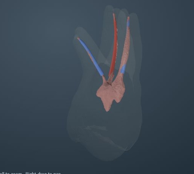 Complete molar ACTA 0036