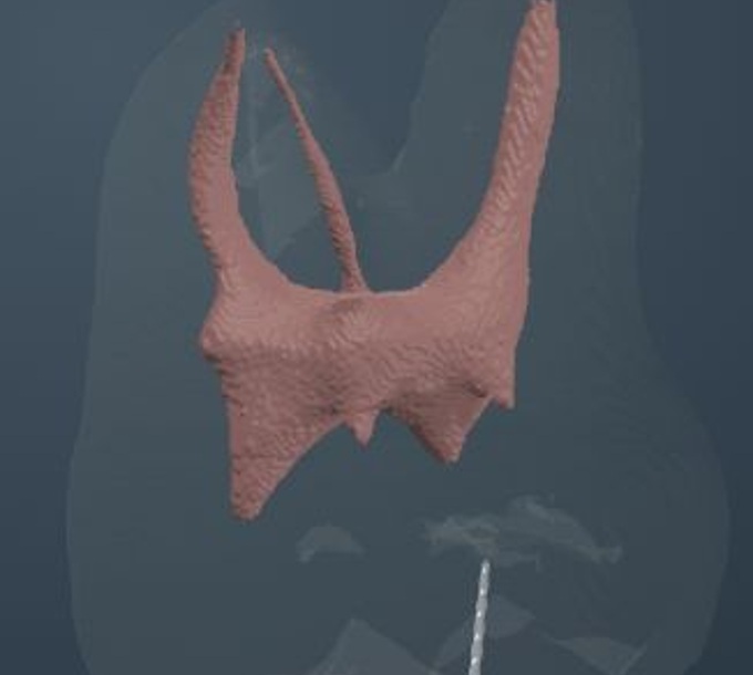 Complete molar ACTA 0006