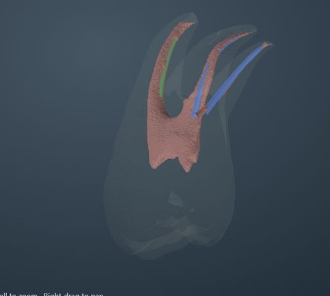 Complete molar ACTA 0027