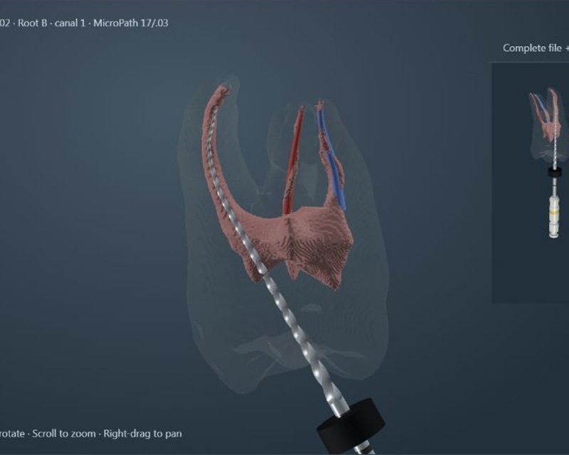 Complete molar ACTA 0002