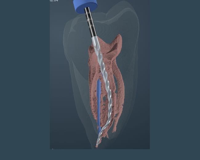 Complete molar ACTA 0014