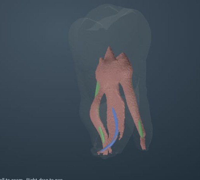 Complete molar ACTA 0040