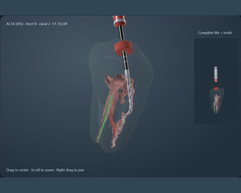 Complete molar ACTA 0056